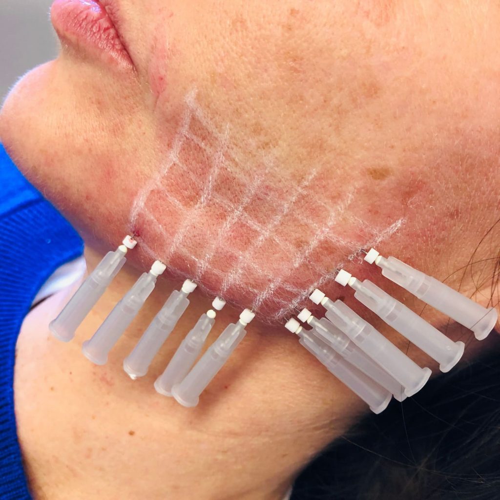 Consejos Y Ayudas Para Tener La Piel Con Calidad Y Sin Arrugas, Con Un Dermatólogo En Barcelona